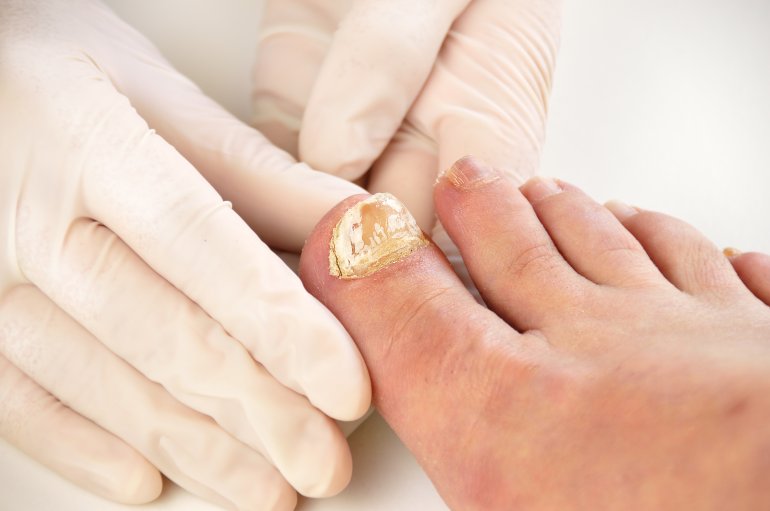 Behandlung von Nagelpilz am Fußzeh