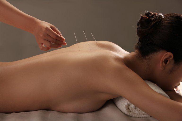 Frau erhält Akupunktur zur Geburtsvorbereitung