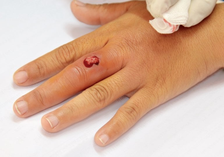 Symptome einer Blutvergiftung nach Verletzung am Finger