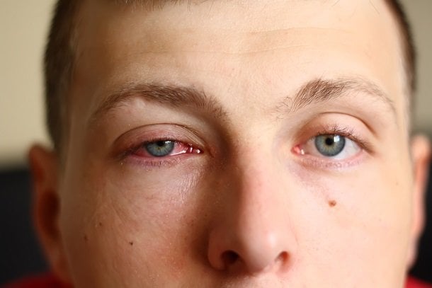 Bindehautentzündung oder gerötete Augen
