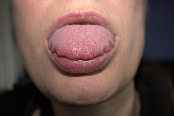Vergrößerte Zunge (Makroglossie)