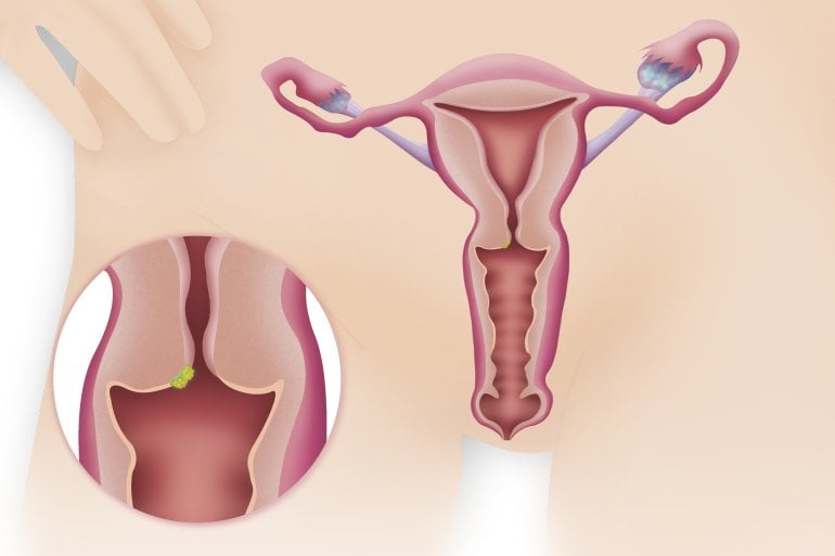 Gebärmutterhalskrebs (Illustration)