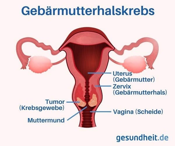 weibliche Geschlechtsorgane mit Gebärmutterhalskrebs (Infografik)