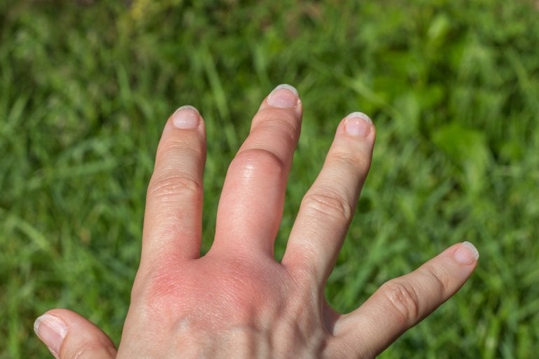 Allergische Reaktion nach Wespenstich