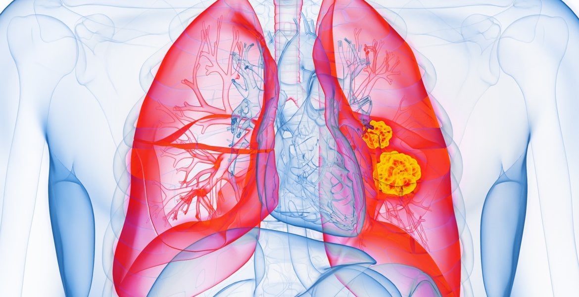 Grafische Darstellung von Lungenkrebs
