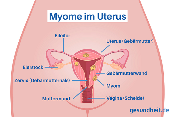 Myom in Gebärmutter (Infografik )