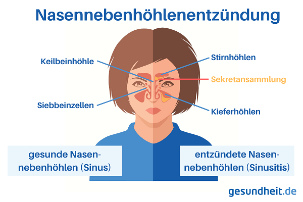 Nasennebenhöhlen und Sinusitis (Infografik)