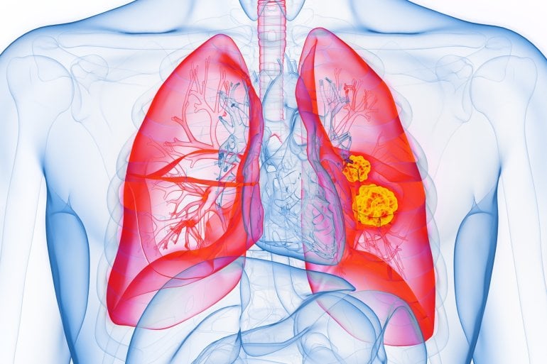 Grafische Darstellung von Lungenkrebs