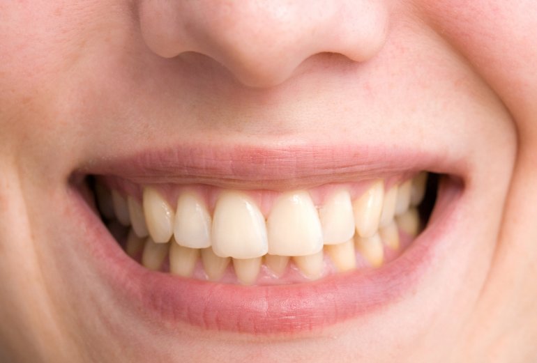 Frau mit gelben Zähnen