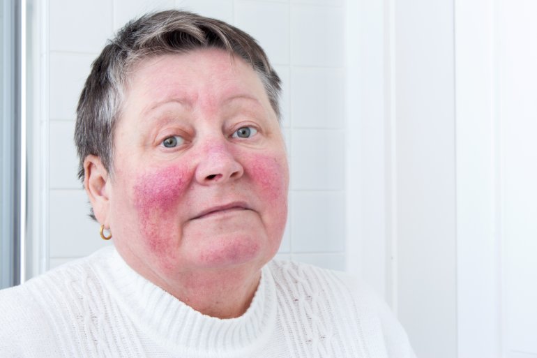 Frau zeigt typische Akne rosacea Symptome