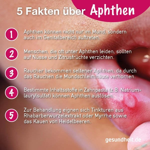 5 Fakten über Aphthen (Infografik)