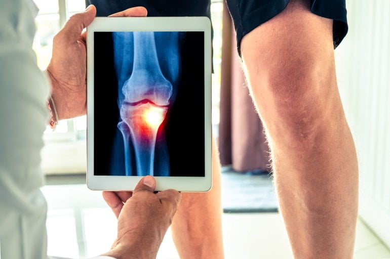 Röntgenbild und Knie eines Mannes mit Arthrose