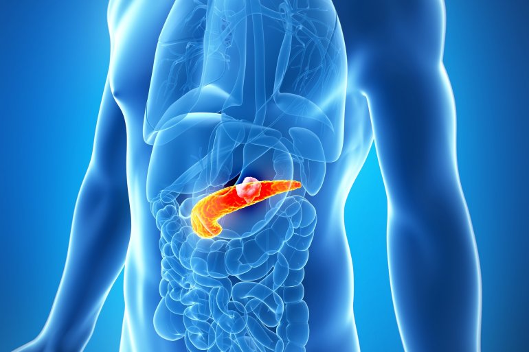 Pankreas mit Bauchspeicheldrüsenkrebs (Illustration)