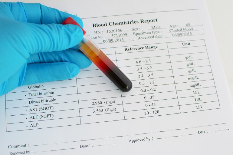 Blutprobe für Bilirubin-Wert