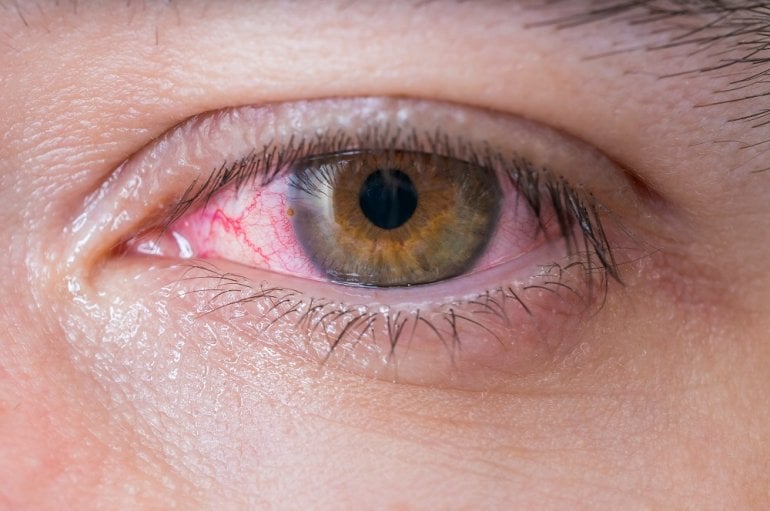 Rotes Auge bei Bindehautentzündung
