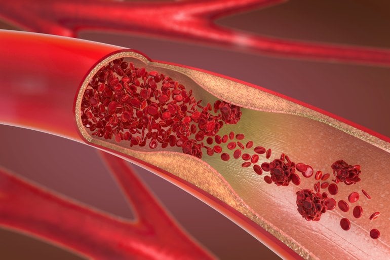 Blutgerinnsel in einem Blutgefäß