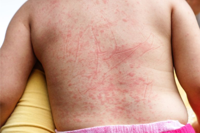 Typischer Hautausschlag am Rücken bei Dengue-Fieber