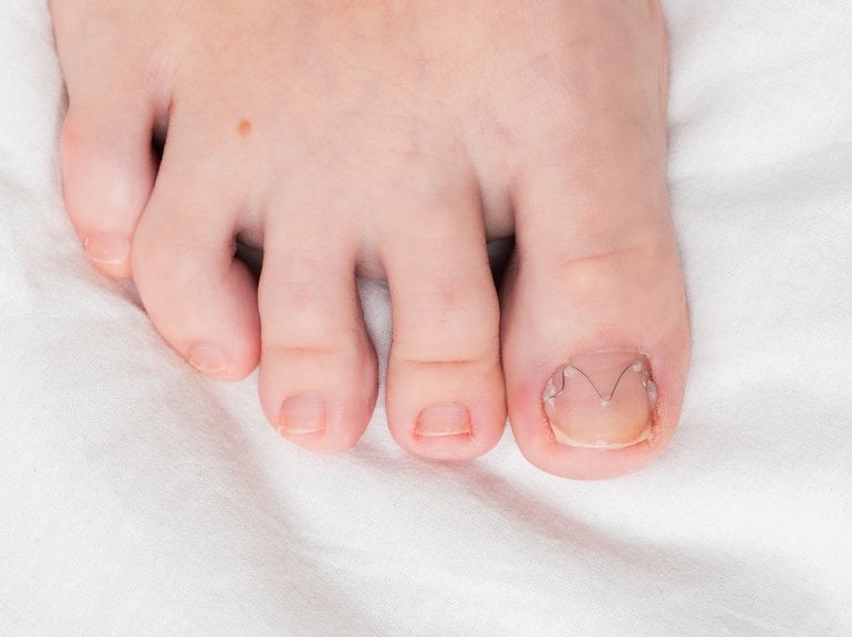 Eingewachsener Zehennagel mit Nagelkorrekturspange