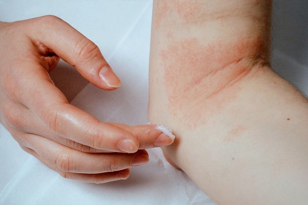 Creme gegen Neurodermitis: Basispflege Creme gegen Neurodermitis: Basispflege