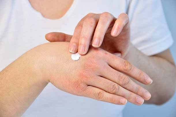 Neurodermitis: Hände brauchen besondere Pflege Neurodermitis: Hände brauchen besondere Pflege