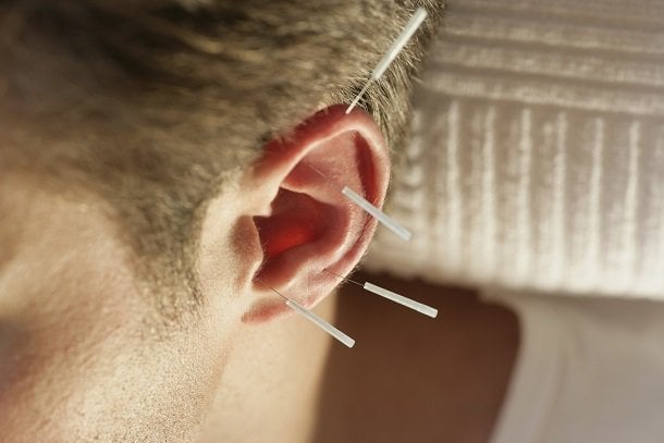 Akupunktur bei Tinnitus