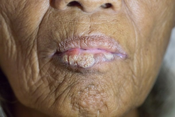 Lippenkrebs: Hautkrebs an der Lippe