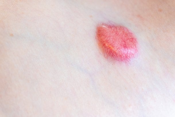Dermatofibrosarkom als seltene Form von Hautkrebs Dermatofibrosarkom als seltene Form von Hautkrebs