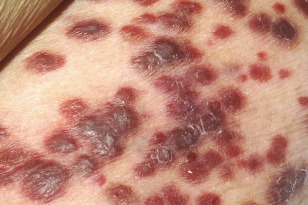 Kaposi-Sarkom – durch Virus verursachter Hautkrebs Kaposi-Sarkom – durch Virus verursachter Hautkrebs
