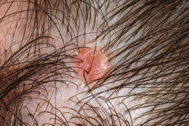 Naevus sebaceus: zunächst gutartiger Hauttumor Naevus sebaceus: zunächst gutartiger Hauttumor