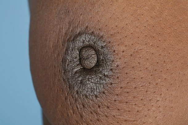 Einziehen der Brustwarze als sichtbares Warnsignal