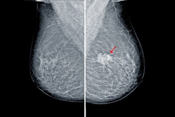 Wie sieht Brustkrebs in der Mammographie aus?