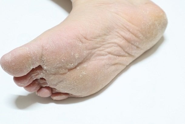 Fußpilz erkennen: Stark verhornte Haut