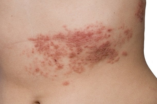 Gürtelrose (Herpes zoster) Gürtelrose (Herpes zoster)