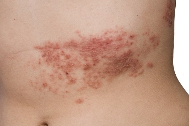 Gürtelrose (Herpes zoster)