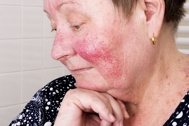 Rosacea Rosacea