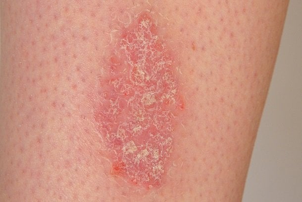 Schuppenflechte (Psoriasis) Schuppenflechte (Psoriasis)