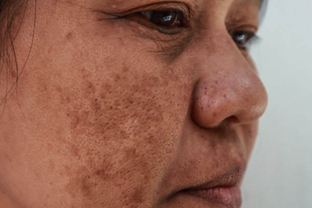 Melasma Melasma
