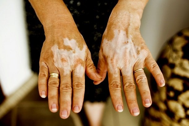Vitiligo (Weißfleckenkrankheit)