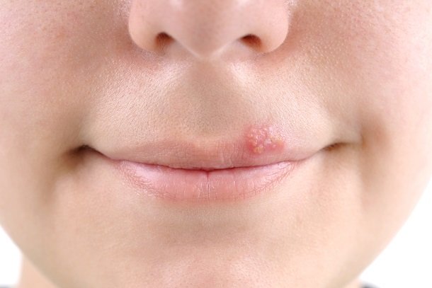 Lippenherpes Lippenherpes