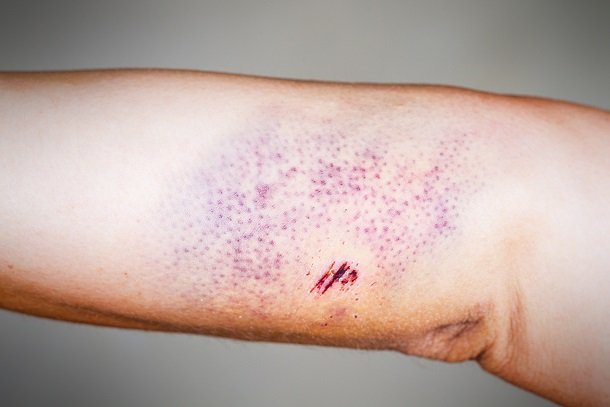Purpura Purpura