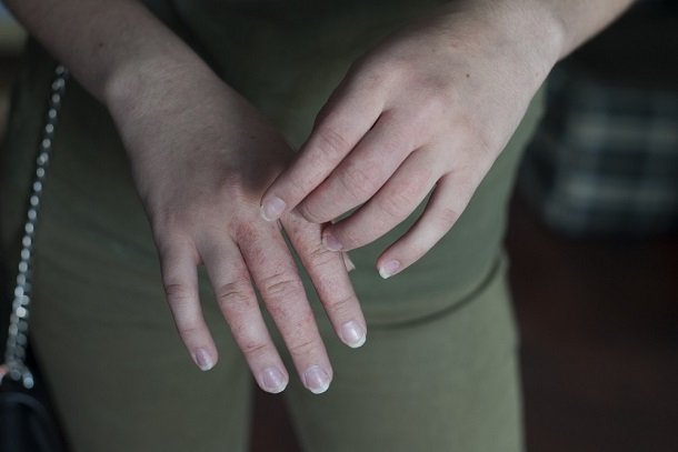 Krätze (Scabies) Krätze (Scabies)