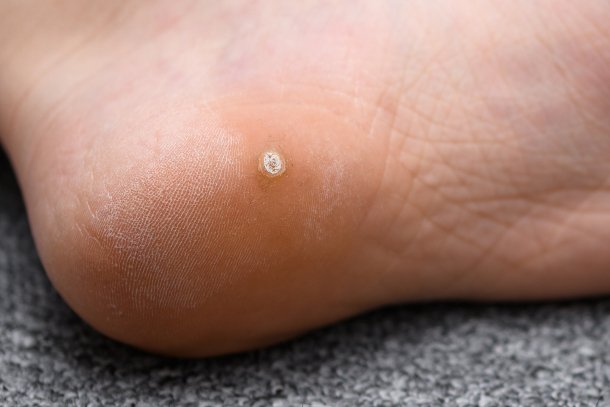 Dornwarze (Plantarwarze) Dornwarze (Plantarwarze)
