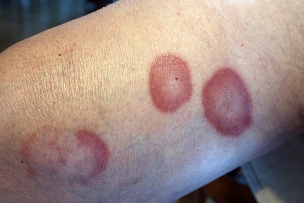 Granuloma anulare Granuloma anulare