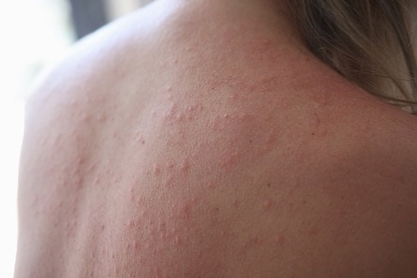 Mallorca-Akne (Acne aestivalis) Mallorca-Akne (Acne aestivalis)