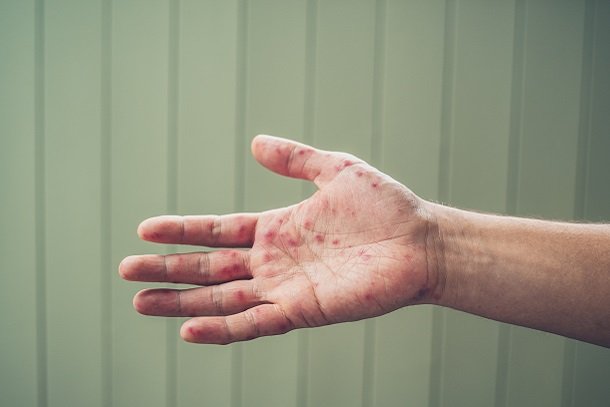 Hand-Mund-Fuß-Krankheit Hand-Mund-Fuß-Krankheit