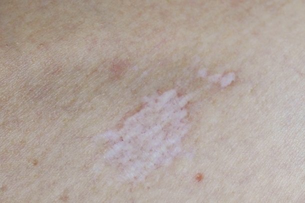 Lichen sclerosus Lichen sclerosus