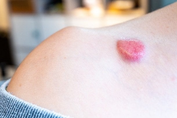 Dermatofibrosarkom Dermatofibrosarkom