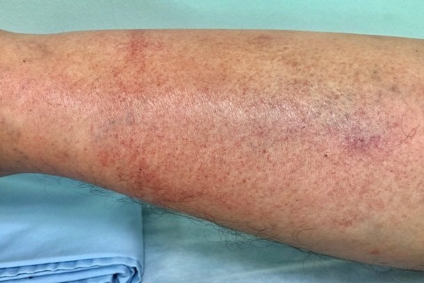 Cellulitis Cellulitis