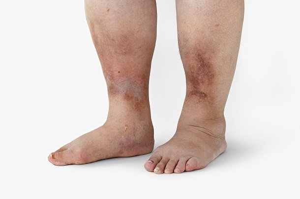 Rote Flecken und andere Hautveränderungen bei Diabetes Rote Flecken und andere Hautveränderungen bei Diabetes