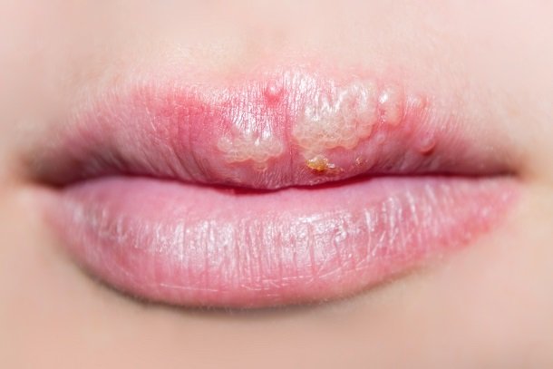 Herpes erkennen: Wie sieht Herpes aus?